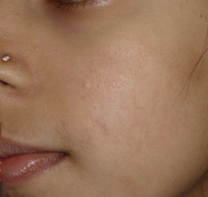 After BodySculpt treatment