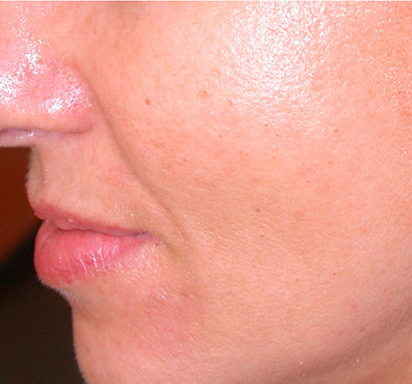 After BodySculpt treatment