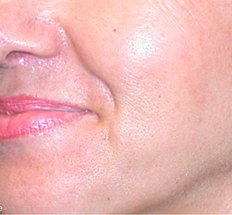 Before BodySculpt treatment