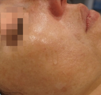 After BodySculpt treatment