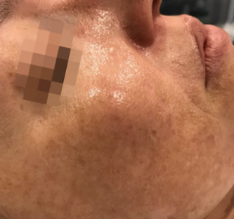 Before BodySculpt treatment