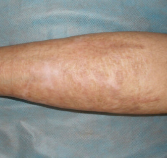 After BodySculpt treatment