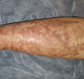 Before BodySculpt treatment