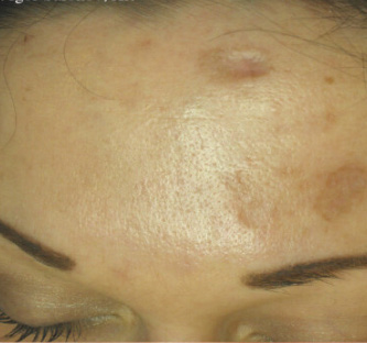 After BodySculpt treatment