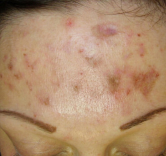 Before BodySculpt treatment